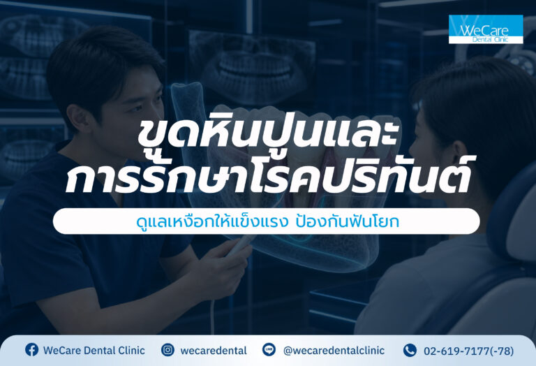 ขูดหินปูนและการรักษาโรคปริทันต์: ดูแลเหงือกให้แข็งแรง ป้องกันฟันโยก