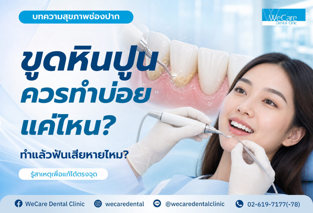 recommended-teeth-scaling-frequency-and-safety-th
